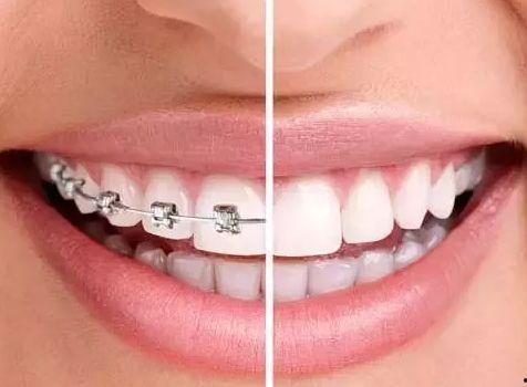 国产阴影矫正牙齿视频,揭秘牙齿阴影矫正的神奇效果  第3张